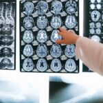 Brain MRI scan — traumatic brain injury settlement value California