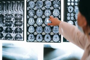 ¿Cuánto Vale un Caso de Lesión Cerebral Traumática en California?